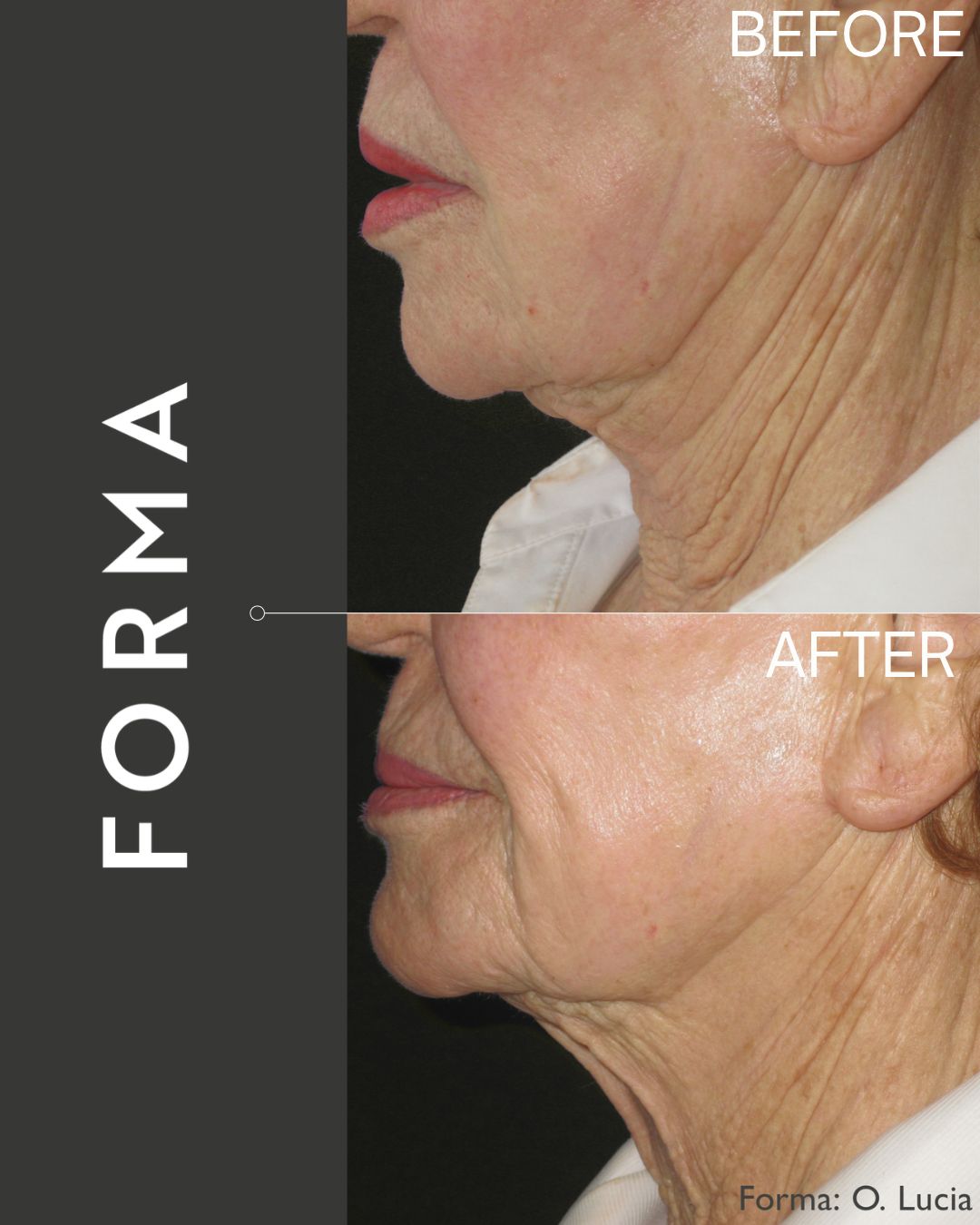 Before and after Luxora aesthetic treatment result