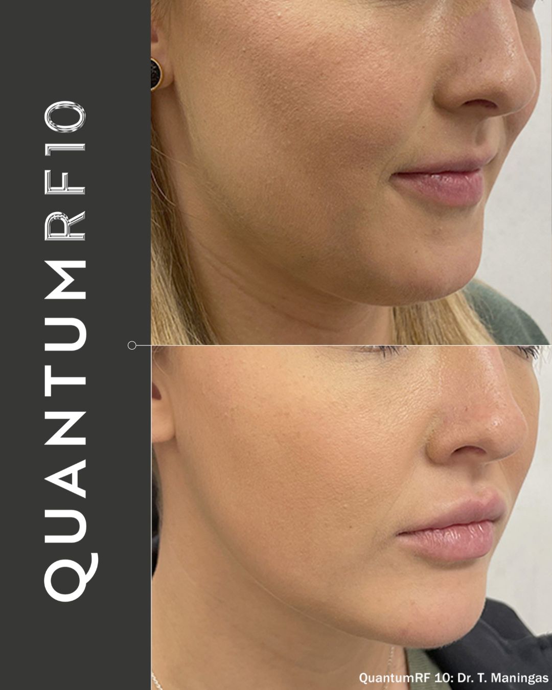 Luxora aesthetic before and after result
