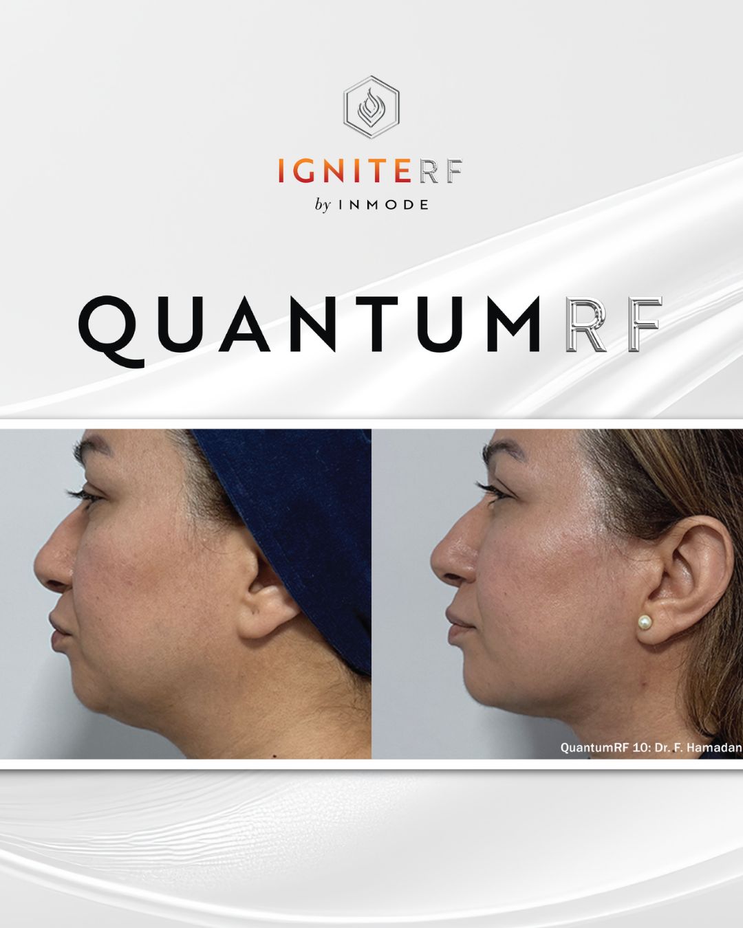 Before and after result using Luxora aesthetic treatment