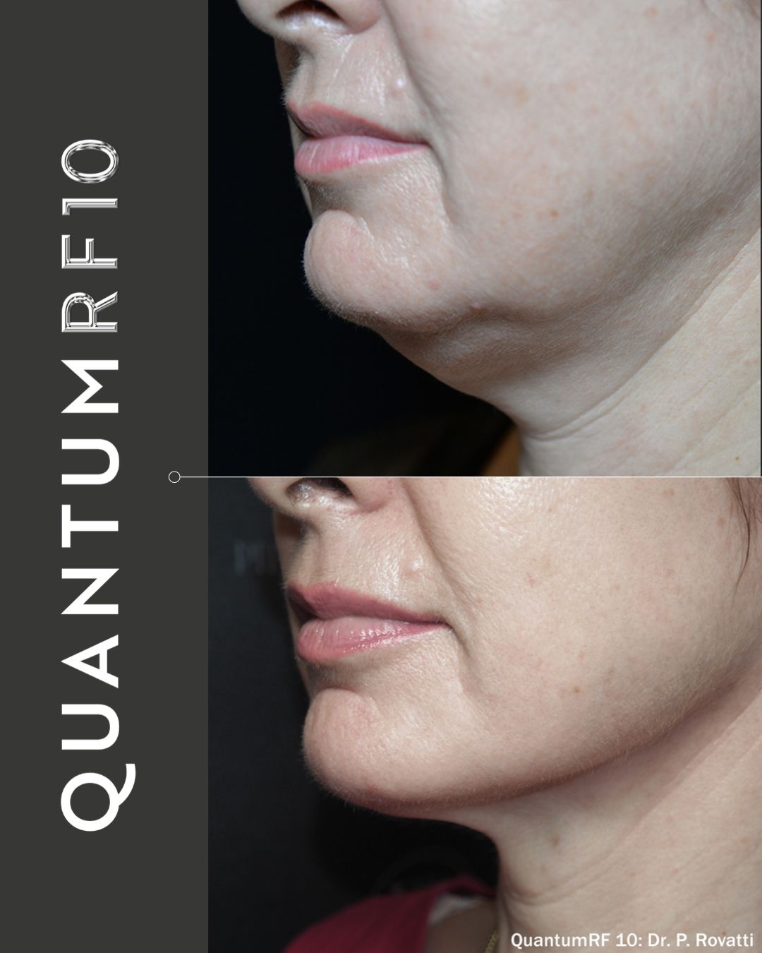Luxora before and after aesthetic treatment result