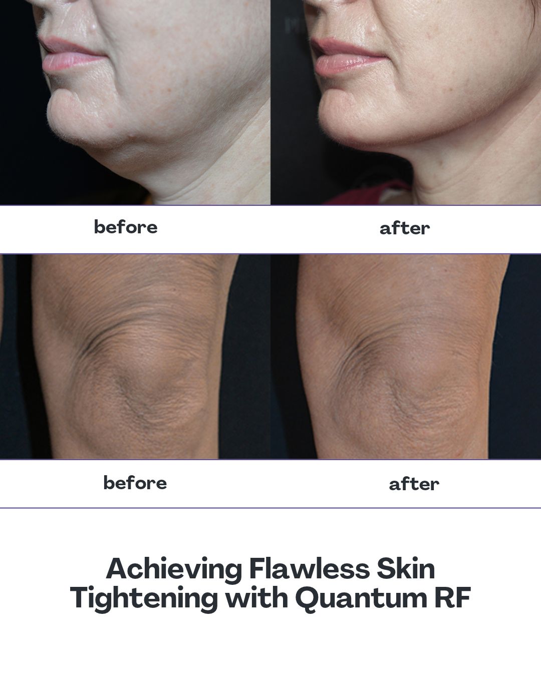 Before and after Luxora treatment result