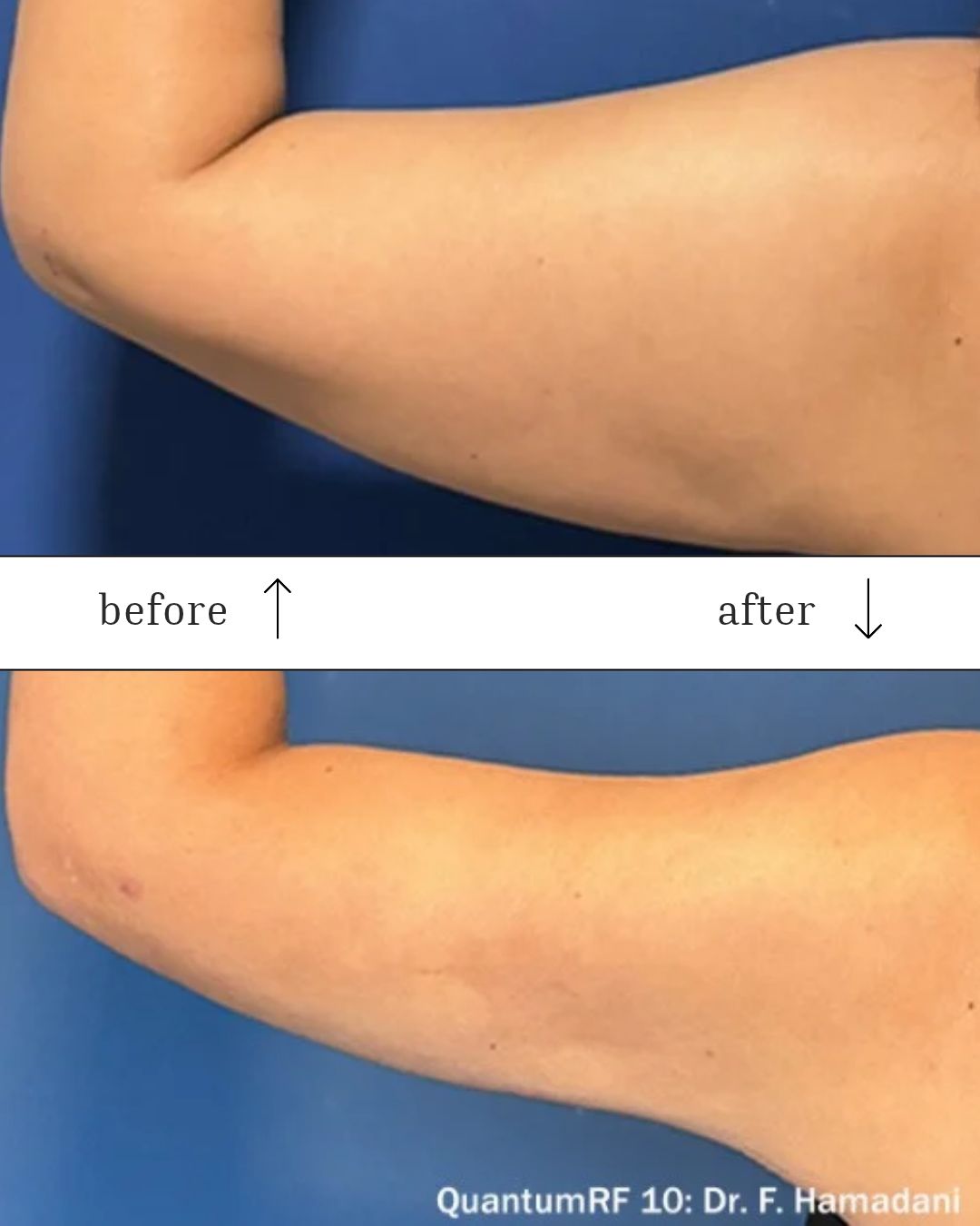 Luxora treatment before and after aesthetic result
