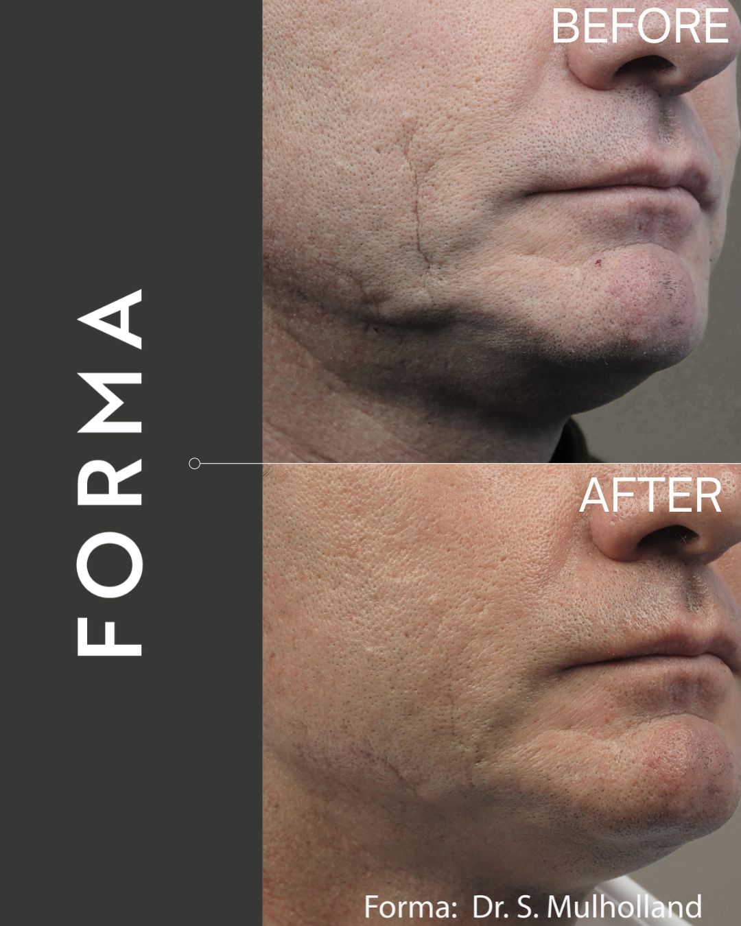 Luxora treatment before and after result
